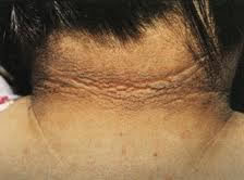 Achantosis Nigricans